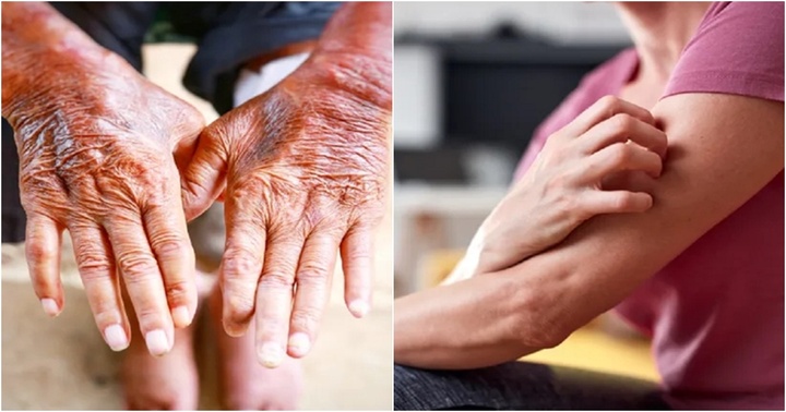 Những dấu hiệu trên da có thể cảnh báo bạn đang gặp vấn đề về thận