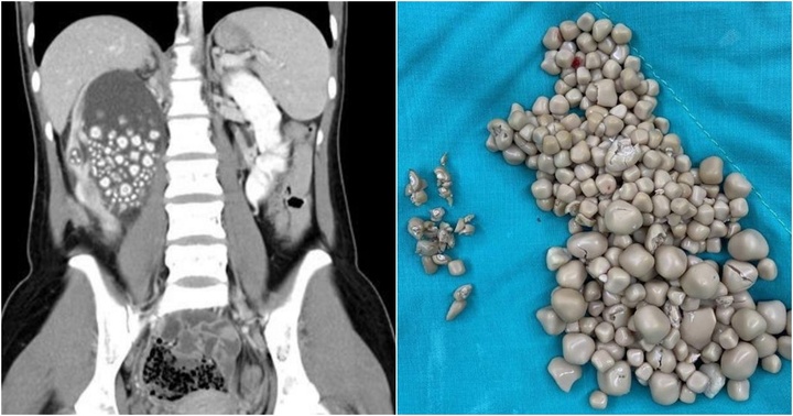 Cô gái ngoài 20 tuổi có hơn 300 viên sỏi thận, nguyên nhân từ thói quen mà nhiều người trẻ mắc phải