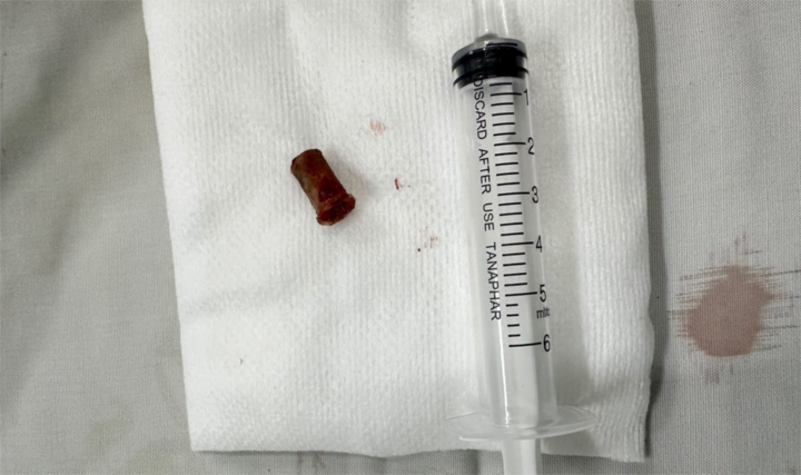 Lấy chiếc còi bị bỏ quên trong đường thở bé trai suốt 7 năm