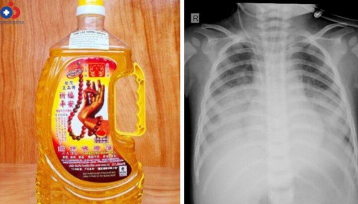 Cấp cứu bé 15 tháng tuổi nguy kịch do uống nhầm dầu thắp đèn