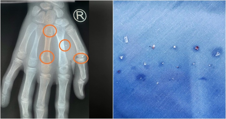 Pháo tự chế phát nổ, nam sinh bị găm 15 mảnh thuỷ tinh vào người