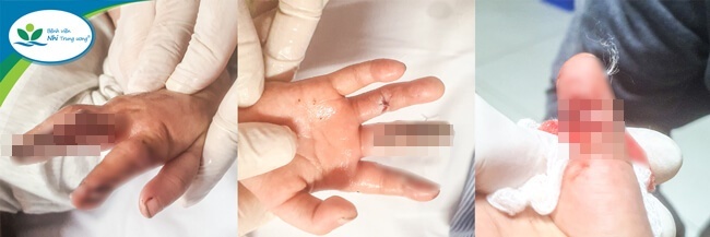 Bệnh nhi 17 tháng tuổi dập ngón tay do máy thêu của gia đình