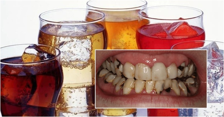 Hàm răng của cô gái mới 22 tuổi khiến nha sĩ giật mình, nguyên nhân đến từ thứ nước mà nhiều bạn trẻ yêu thích