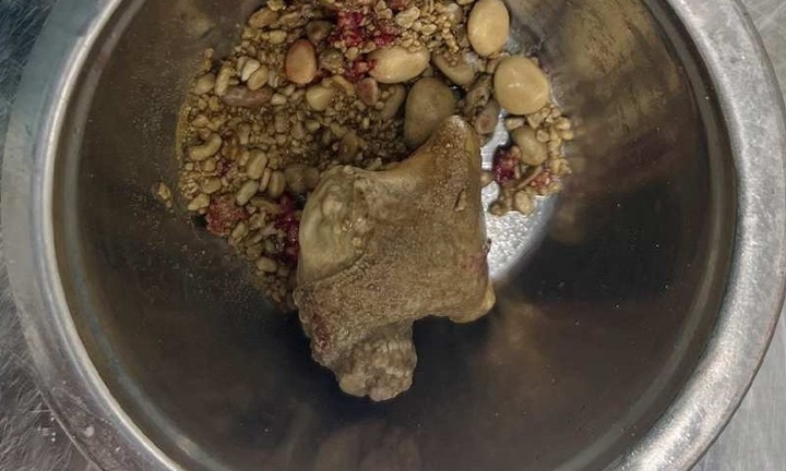 Phát hiện hàng trăm viên sỏi trong thận trái của chàng trai 26 tuổi