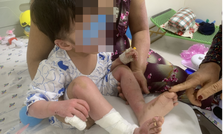 Bé gái 27 tháng tuổi bỏng nặng do bình gas mini phát nổ