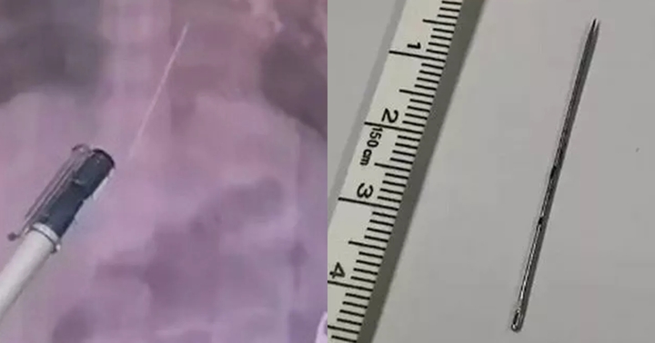 Trung Quốc: Bé gái sống sót kỳ diệu khi bị kim khâu đâm vào tim