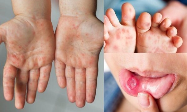 Bé trai ở Đắk Lắk tử vong vì bệnh tay chân miệng