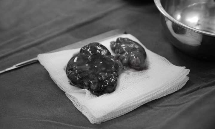 Phẫu thuật thành công khối u “khổng lồ” cho người phụ nữ 60 tuổi