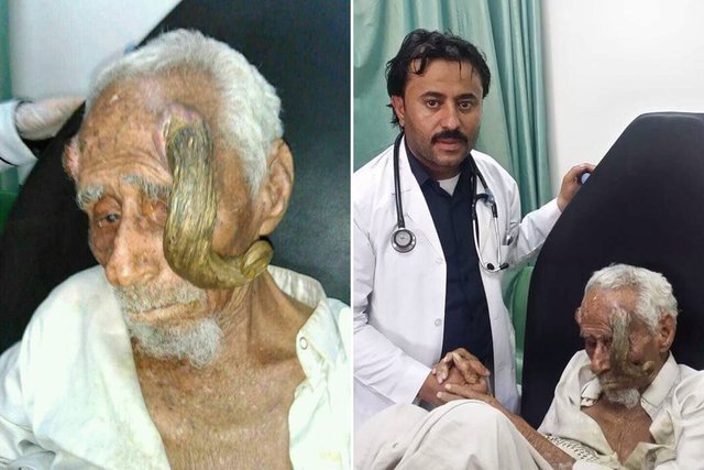 Người đàn ông không qua khỏi sau khi cắt “sừng”