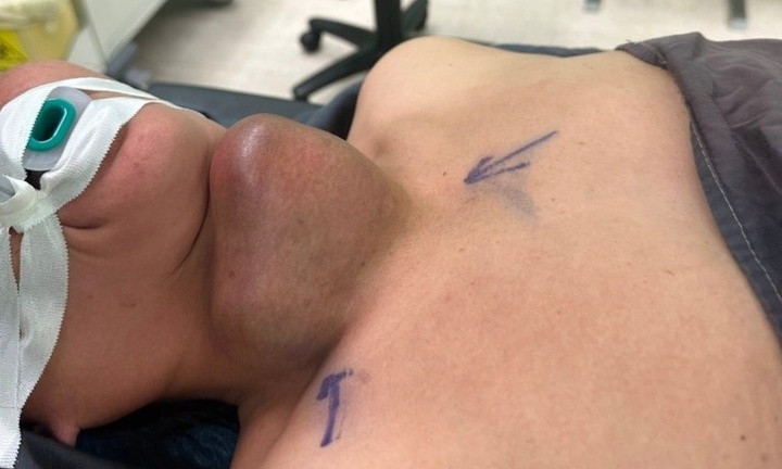 Tự ý mua thuốc nam về đắp, người phụ nữ phải nhập viện vì áp xe tuyến giáp