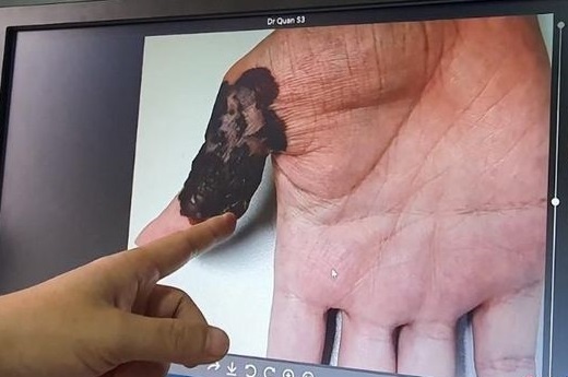 Phát hiện ung thư từ nốt ruồi trên bàn tay