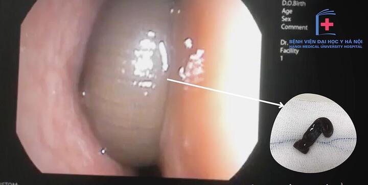 Chảy máu cam 3 tháng, người đàn ông đi khám thì phát hiện con đỉa dài 6cm còn sống trong hốc mũi