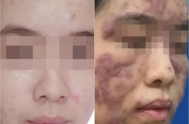 Tin lời “bác sĩ online”, cô gái trẻ bị biến dạng gương mặt và có nguy cơ bị mù