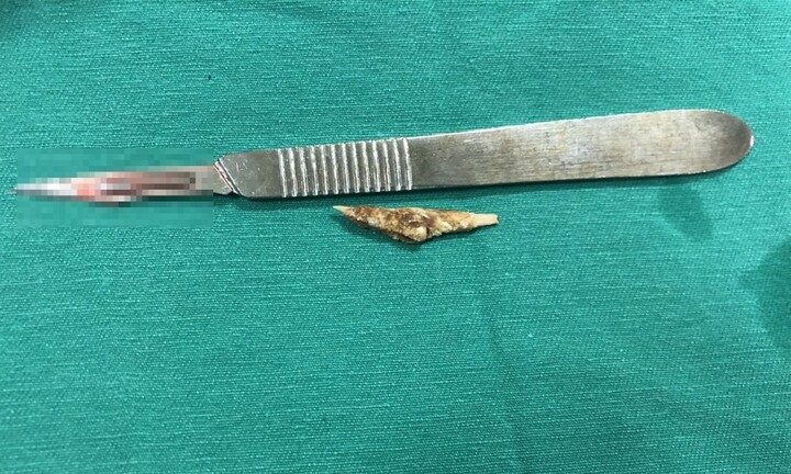 Người đàn ông đau bụng nhiều năm đi khám mới phát hiện mảnh xương gà ở vùng hậu môn