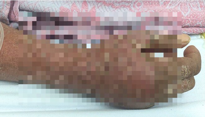 Người đàn ông tróc vảy khắp cơ thể do dị ứng thuốc kháng lao