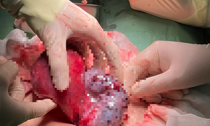 Cần Thơ: Kịp thời cứu sống  bé gái 15 tuổi bị u buồng trứng biến chứng