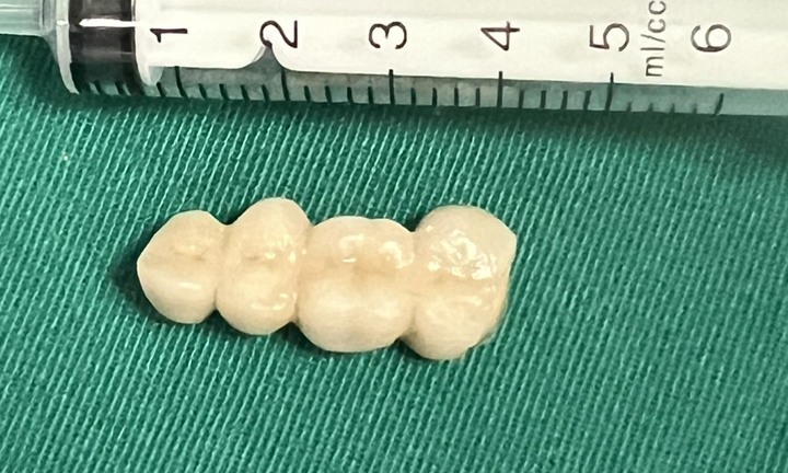 Bà đỡ cháu bị ngã vô tình nuốt phải 4 chiếc răng giả