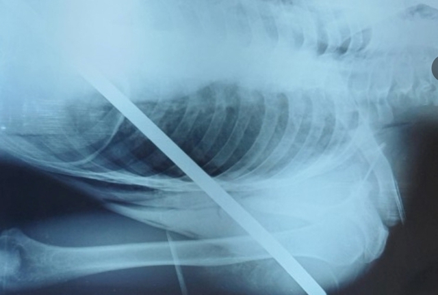 Cứu sống nam thanh niên bị 2 thanh sắt đâm xuyên người