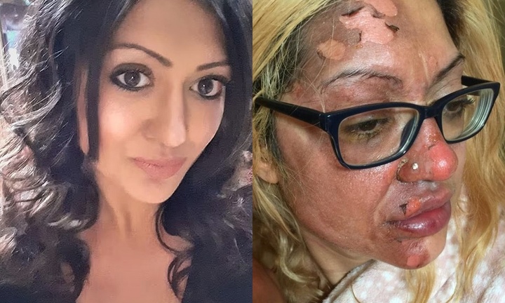 Người phụ nữ bị bỏng nặng ở mặt chỉ vì bắt chước theo trend Tik Tok