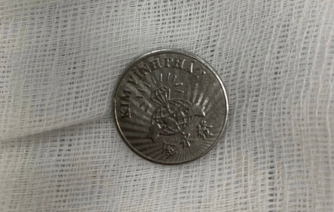 Bé gái 10 tuổi ngậm đồng xu chơi rồi vô tình nuốt phải