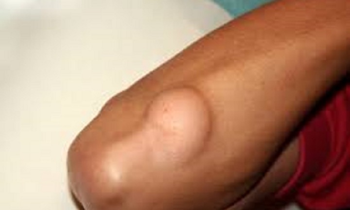 Bé gái phát hiện ung thư hiếm gặp từ dấu hiệu đau nhức tay trái