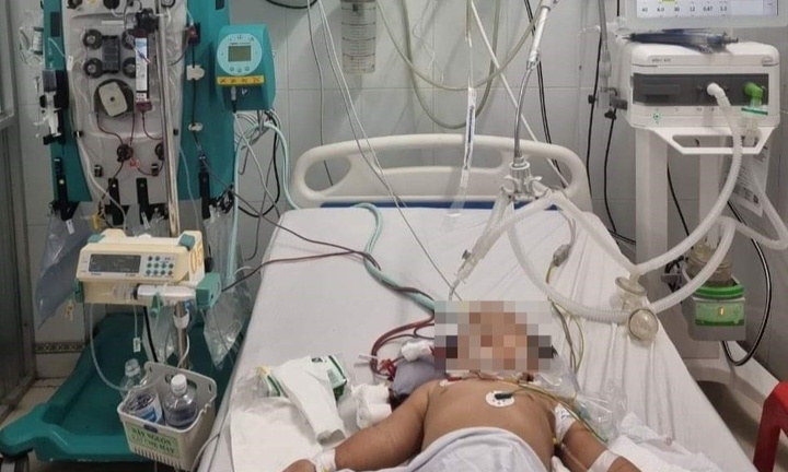 Bé gái 2 tuổi phải lọc máu cấp cứu sau 2 ngày sốt nhẹ vì tay chân miệng