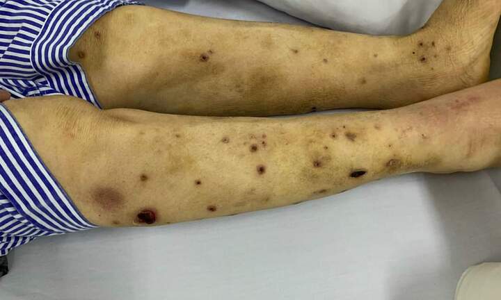 Hà Nội: Bệnh nhân đái tháo đường nhiễm trùng da nghiêm trọng chỉ vì thầy lang chữa bệnh bằng cách cho ong đốt