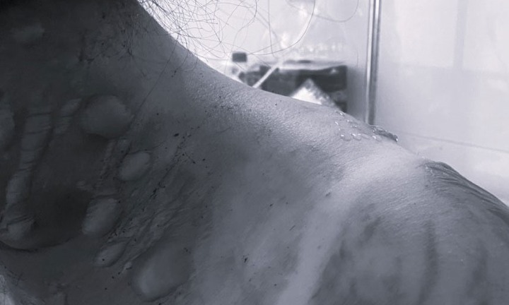 Người phụ nữ bị bỏng nặng do nổ bình ga khi đang nấu ăn