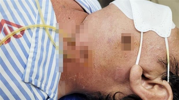 Phẫu thuật thành công cho bệnh nhân bị áp xe vùng cổ