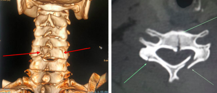 Trèo cây hái vải người phụ nữ ngã gãy đốt sống cổ