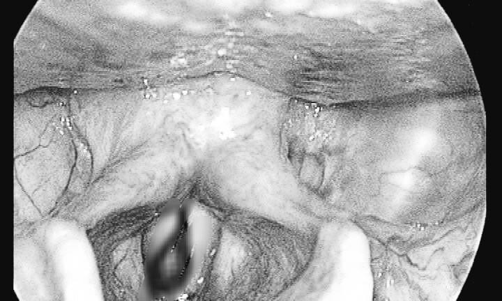 Cao Bằng: Người đàn ông bị đỉa chui vào cổ họng nhưng không hề hay biết