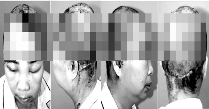 Ghép thành công mảnh da đầu bị đứt rời cho người phụ nữ bị cuốn vào máy khoan giếng