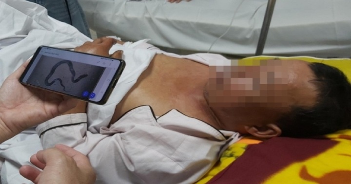 Người đàn ông nhập viện cấp cứu sau khi bị rắn hổ mang cắn