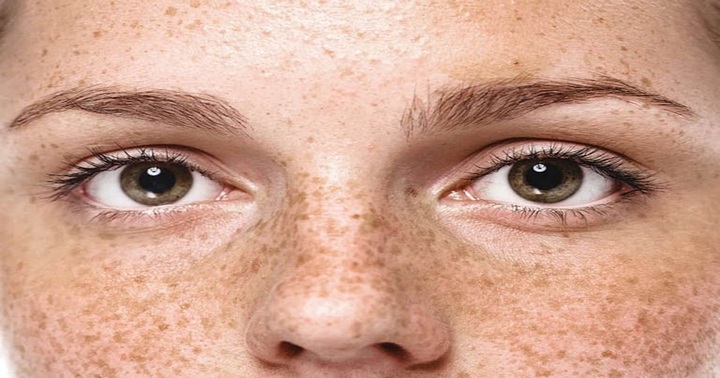 Tại sao tàn nhang thường xuất hiện nhiều và đậm màu hơn vào mùa hè?