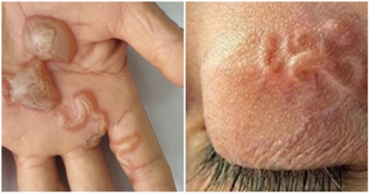 Nhiễm ấu trùng giun đũa vì thói quen thường gặp ở người hay nuôi thú cưng