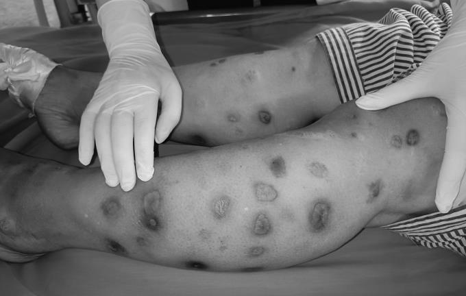 Tuyên Quang: Mua canxi về tự tiêm vào cơ bắp người phụ nữ bị hoại tử da