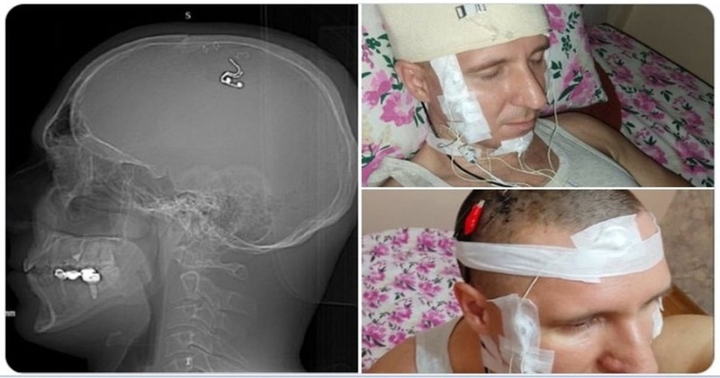 Suýt chết vì tự khoan hộp sọ để cấy điện cực vào não để kiểm soát giấc mơ