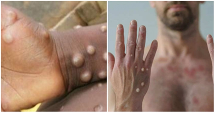  Đồng Nai: Ghi nhận một ca bệnh dương tính với virus đậu mùa khỉ