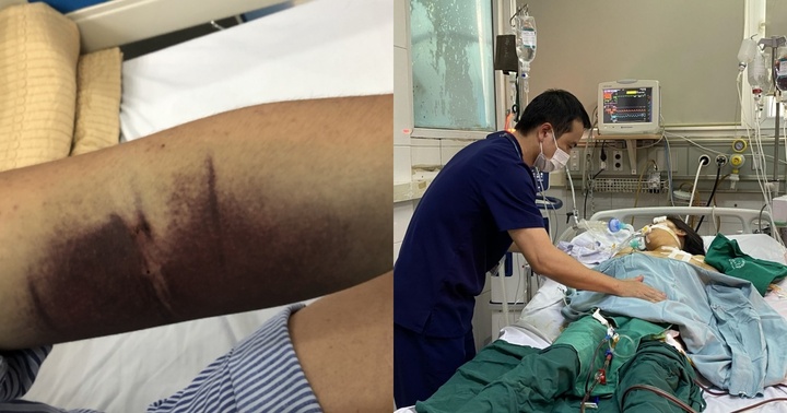 Cảnh báo về nguy cơ biến chứng nặng ở người bệnh đái tháo đường mắc sốt xuất huyết