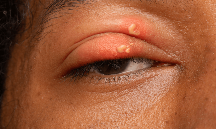 Cảnh báo biến chứng nguy hiểm của zona thần kinh