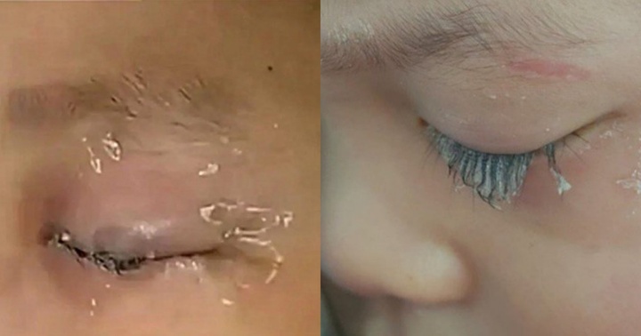 Thấy bố hay nhỏ thuốc đau mắt, cậu bé tò mò bắt chước làm theo nhưng lại bằng “keo 502”