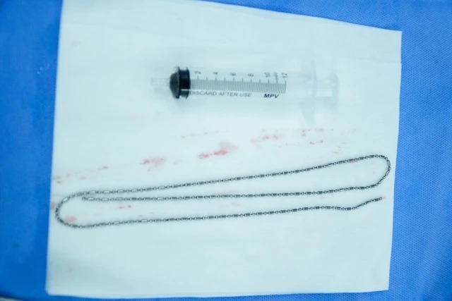 Nam sinh phải cấp cứu do tự nhét dị vật 60 cm vào