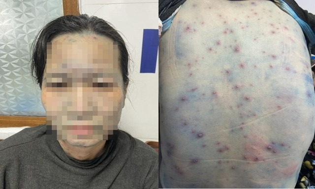 Nữ giáo viên mắc thủy đậu bội nhiễm sau khi tiếp xúc với hai học sinh mắc thủy đậu