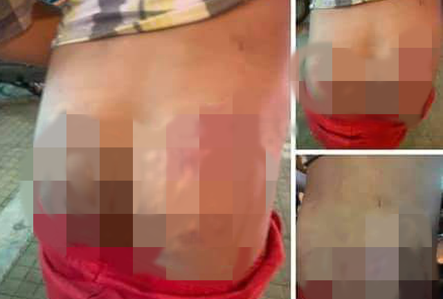 Tình tiết mới vụ cô giáo đánh học sinh tím bầm mông ở Lâm Đồng