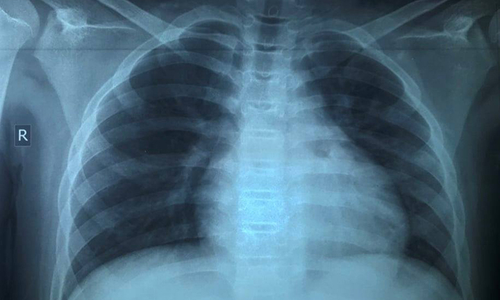 Điều trị thành công bé trai 13 tuổi mắc COVID-19 tổn thương phổi nặng