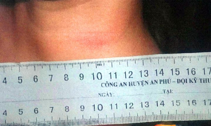 Sự thật việc cô gái 23 tuổi tự gây thương tích giả bị cướp