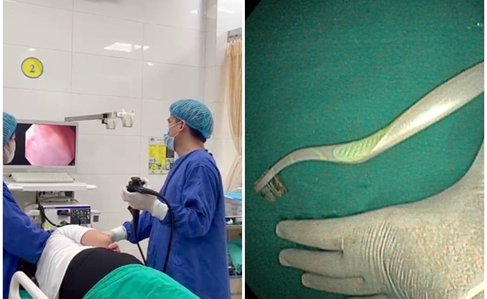 Hy hữu: Nữ sinh 21 tuổi cả bàn chải đánh răng 20cm vào bụng