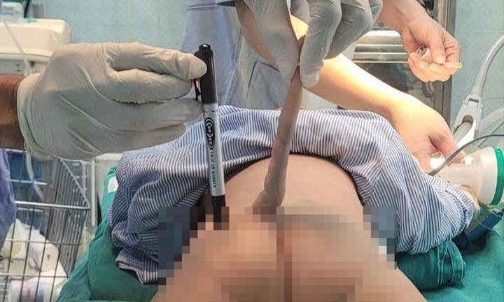 Phẫu thuật thành công đuôi dị tật dài 14cm cho một bệnh nhi 4 tháng tuổi