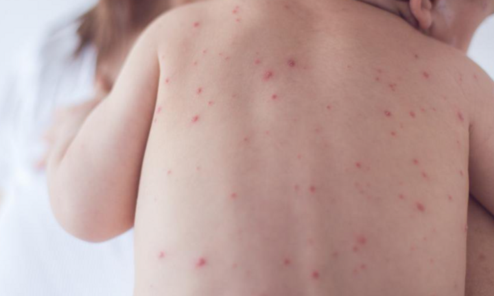 42 ca nghi mắc bệnh sởi, Bộ Y tế đề nghị rà soát việc tiêm chủng