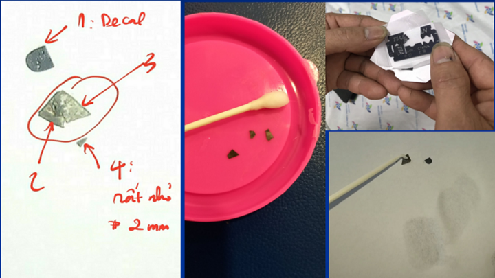 Tin tức đời sống ngày 1/6: Bé gái 15 tháng tuổi nuốt 7 mảnh dao lam vào bụng